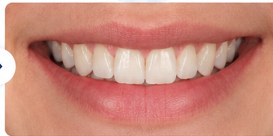 After example of adult clear aligner treatment with improved smile alignment
