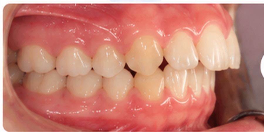 Before example of bite improvement orthodontic treatment