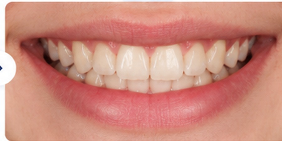 After example of teen braces treatment with straighter teeth